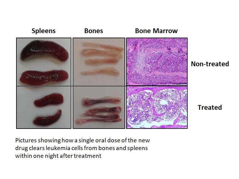 Leukemia cancer cells before and after treatment